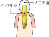インプラントは、どんな治療方法ですか？