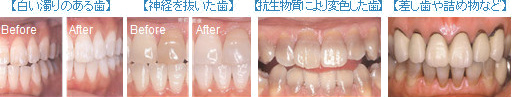 ホワイトニングできない（効果が薄い）